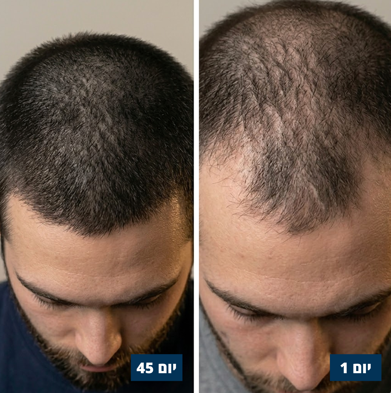 סרום לנשירת שיער - Lorex