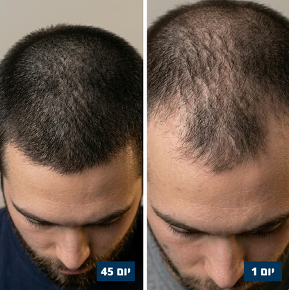 סרום לנשירת שיער - Lorex